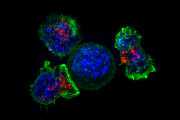 Иммунотерапия после операции по поводу рака мочевого пузыря может уменьшить рецидивы